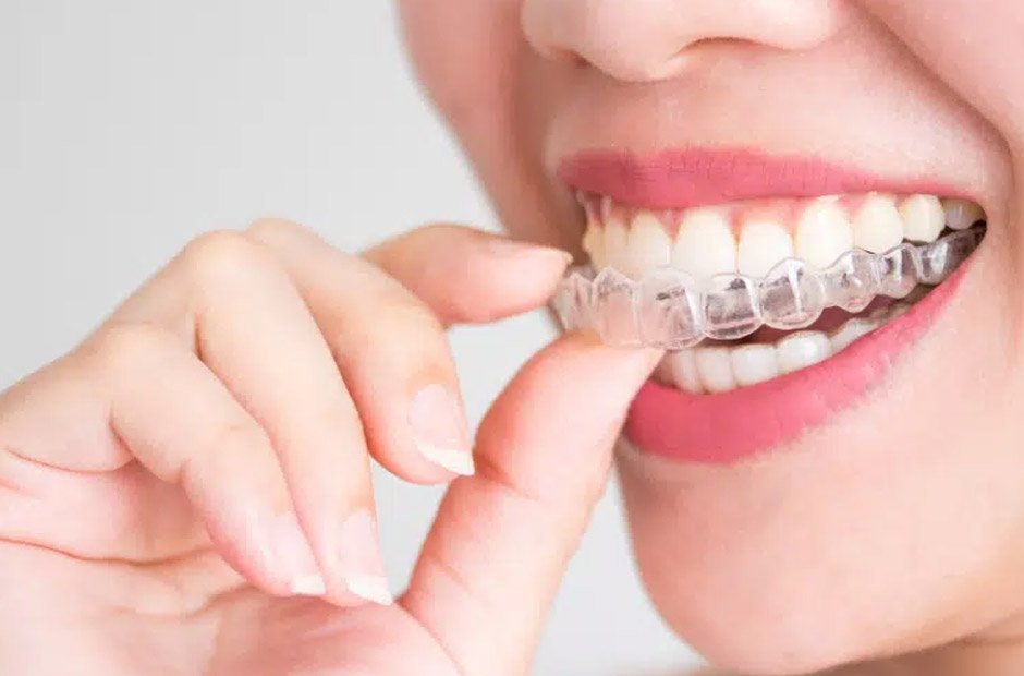 Everything you need to know about Clear Aligners