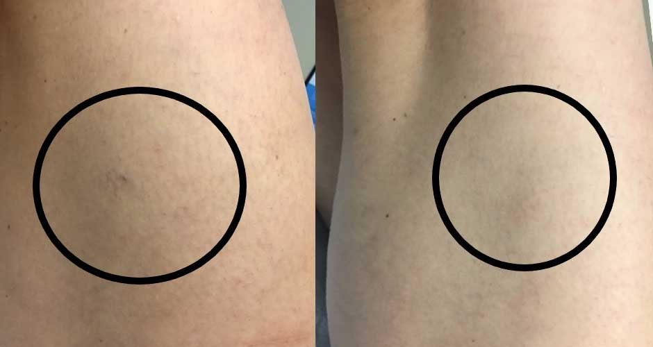 How-to-Maintain-Healthy-Skin-After-Tattoo-Removal