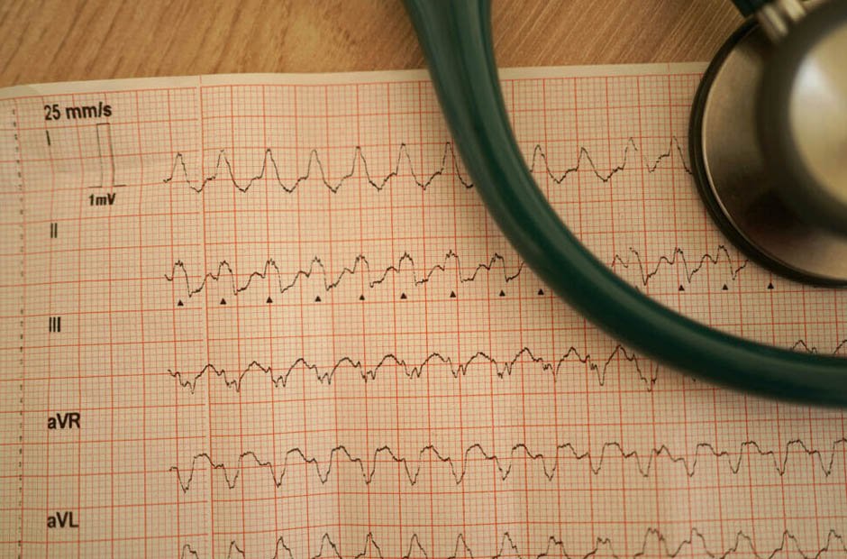 PALS Narrow QRS Tachycardia with Good Perfusion