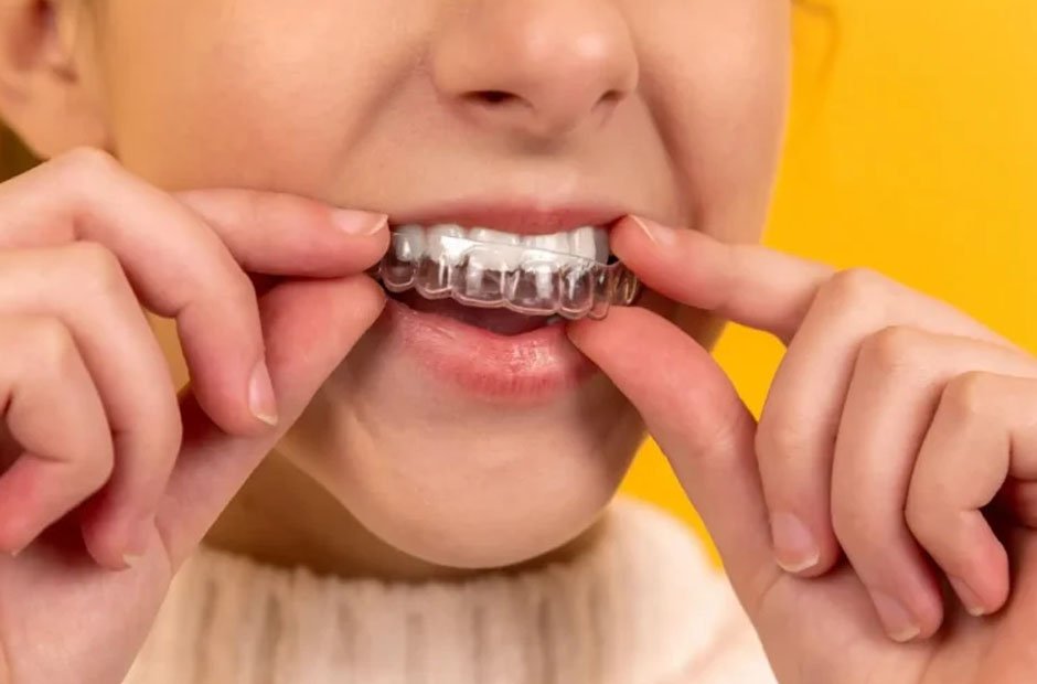 Top 5 Affordable Invisible Braces for a Perfect Smile