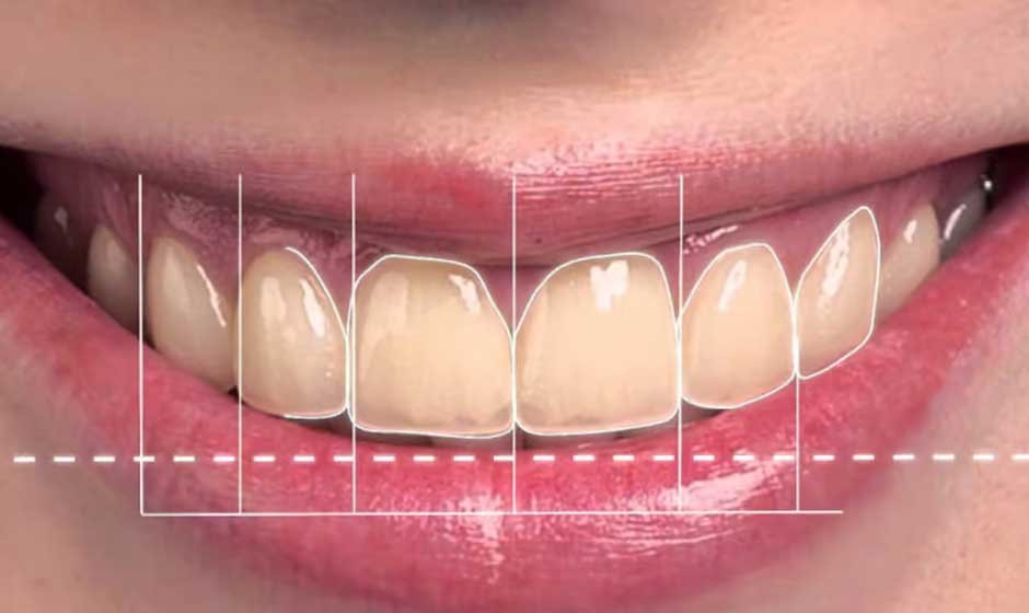 How Does Digital Smile Design Work