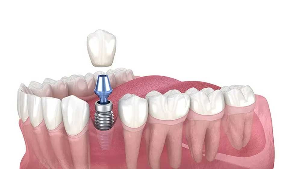 How Long Do Dental Implants Last