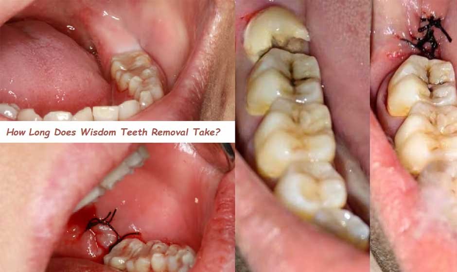 How Long is Wisdom Teeth Recovery?