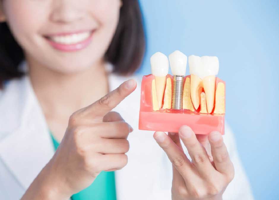 Key Things Patients Need To Know About Dental Implants