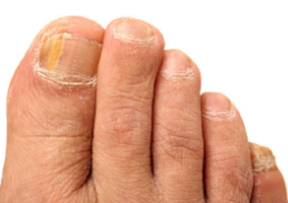 Can Fungal Nail Infections Be Prevented