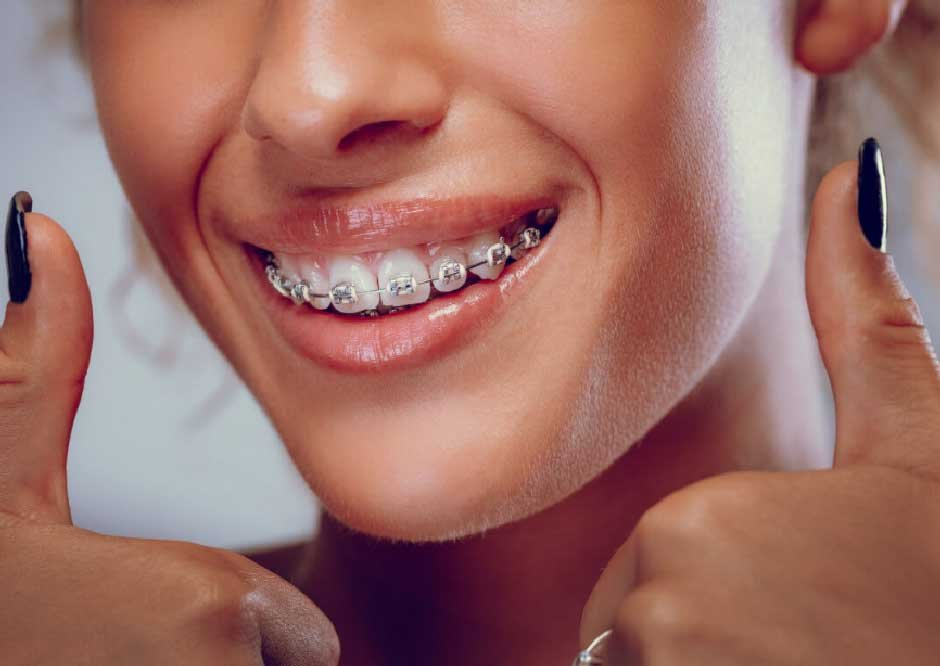 The Path to a Perfect Smile: Why More Adults Are Getting Braces