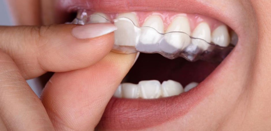 How Invisible Aligners in Surrey Can Transform Your Smile Without Braces